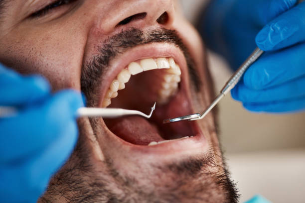Best Knocked-Out Tooth (Avulsed Tooth) Treatment in Frankfort, IN