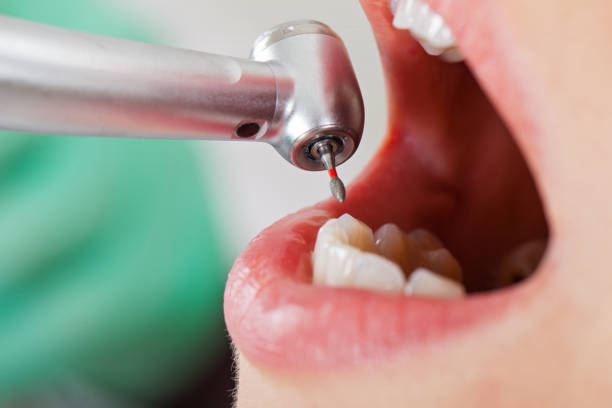Best Dental Abscess Treatment in Frankfort, IN